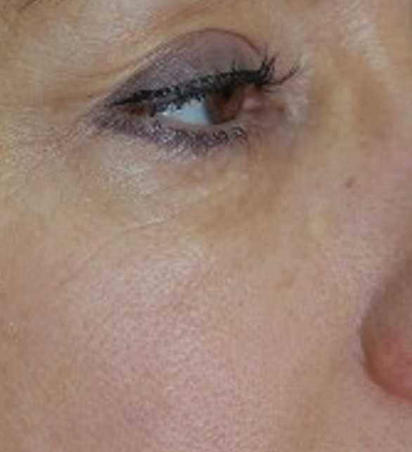 Уход за кожей вокруг глаз | чистая линия