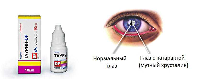 Катаракта лечение | офтальмологическая глазная клиника "нью вижн"