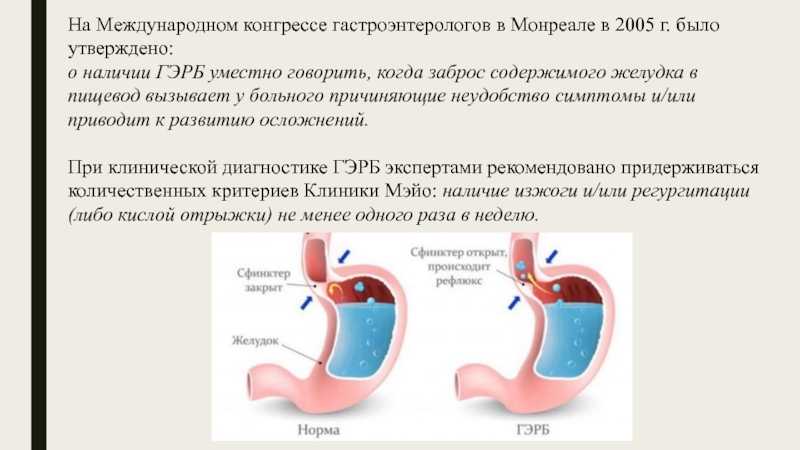 Как восстановить защитные свойства желудка при рефлюксной болезни