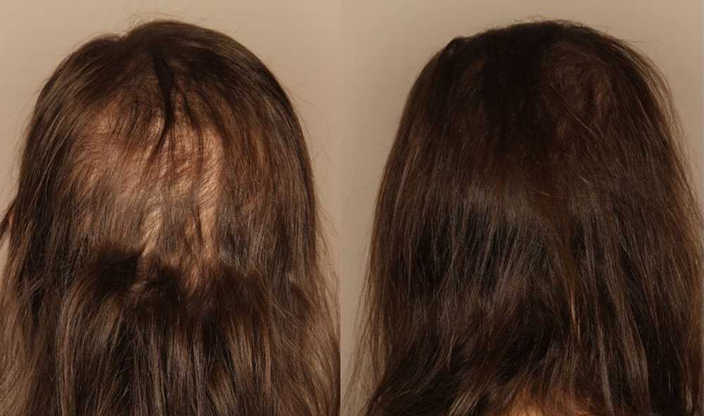 Алопеция у женщин лечение отзывы. Диффузное телогеновое выпадение волос. Мезотерапия волос до и после. Выпадение волос до и после.