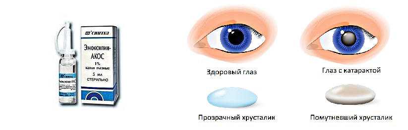 Врожденная катаракта в клинике микрохирургии глаза