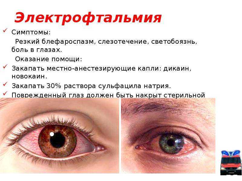 Попадание в глаз кислоты. Покраснение глаз и слезотечение. Светобоязнь слезотечение блефароспазм. Воспаление покраснение глаза.