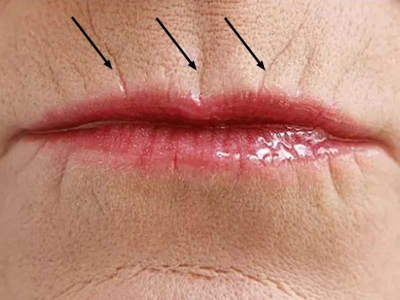 Как убрать кисетные морщины – эффективные методы борьбы с кисетными морщинами вокруг рта